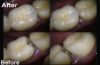 Picture of A.C.E PFM Crowns & Ceramic Repair Kitbox