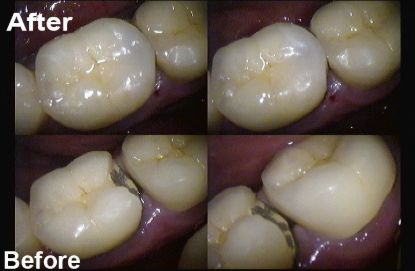 Picture of A.C.E PFM Crowns & Ceramic Repair Kitbox