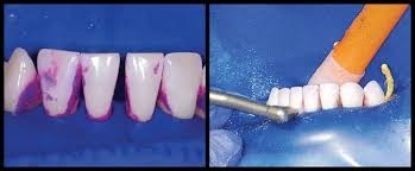 Picture of Bioclear Dual Colour Disclosing Solution