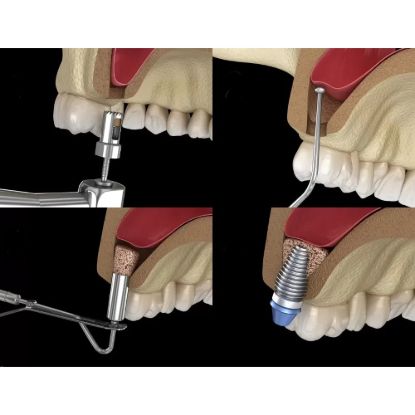 Picture of Bone Wax ETHICON™ For Instant Stopping Bony Bleeding
