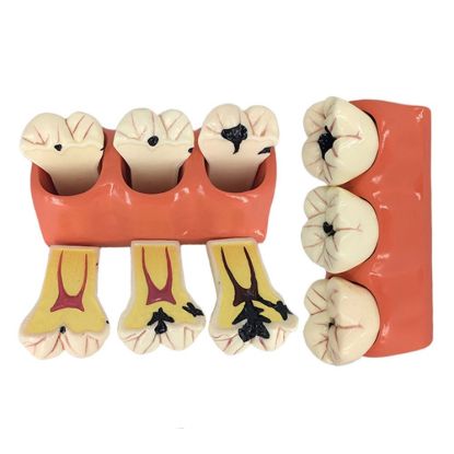 Picture of Caries Probe AIZ Original