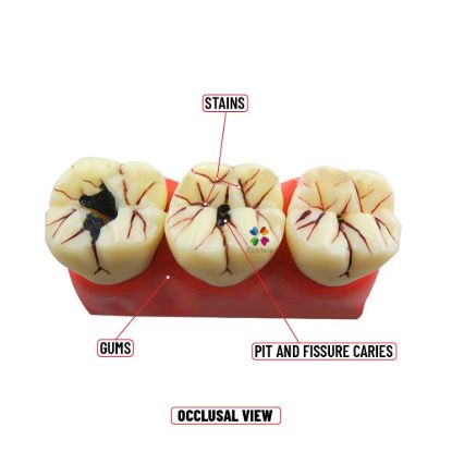 Picture of Caries Probe AIZ Original