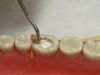 Picture of CAVITON Temporary Filling Material GC Fuji Japan