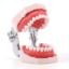 Picture of Orthodontic Teeth Model