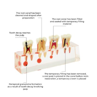 Picture of Root Canal Re-Treatment Files Dentsply Sirona Type Pattern