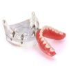 Picture of Teeth Model With Dental Disease Restoration Bridge Implant